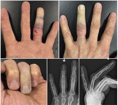 Closed Ring Avulsion Injury With Isolated Arterial Insufficiency ...