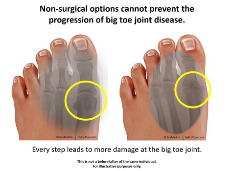 Swollen Big Toe Joint Pain