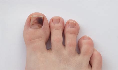 Black Under Toenail