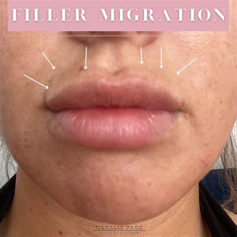 What is filler migration? | Lip fillers, Face fillers, Botox fillers