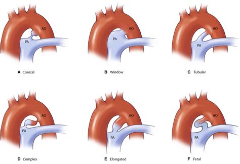 Patent Ductus Arteriosus: A Contemporary Perspective for the Pediatric and Adult Cardiac Care ...