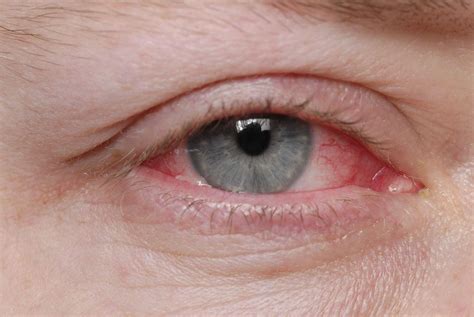 How Long Is Pink Eye Contagious?