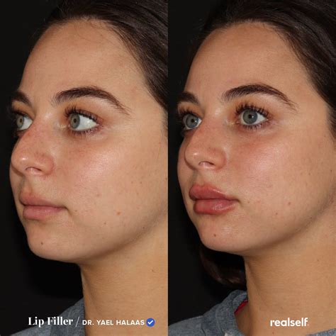 Depending on which filler you opt for, results can last anywhere from three to 12 months ...