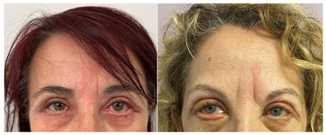 Persistent Conjunctival Chemosis after Lower Lid Blepharoplasty: A Comparison of Different ...