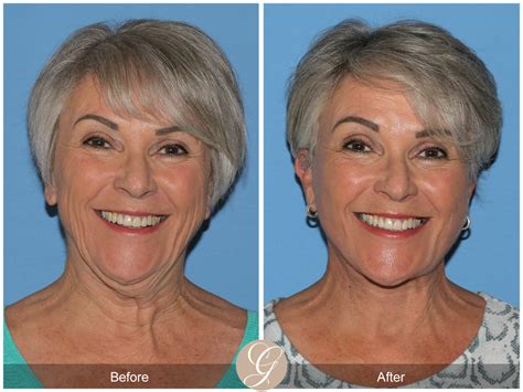 The Difference Between Deep Plane Facelift and SMAS Facelift | Sadati, MD