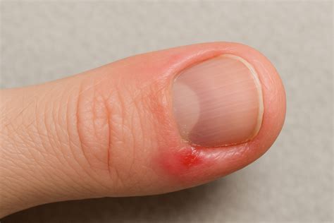 Top reason Ingrown Fingernail at Home | Step-by-Step Guide