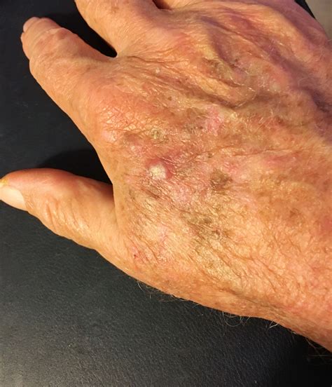Itchy White Bumps On Skin