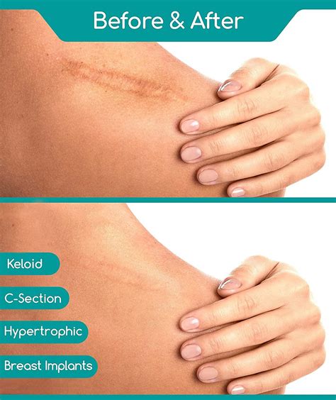 Medi Grade Silicone Scar Sheets [12pc] - Reusable Strips for C-Section ...