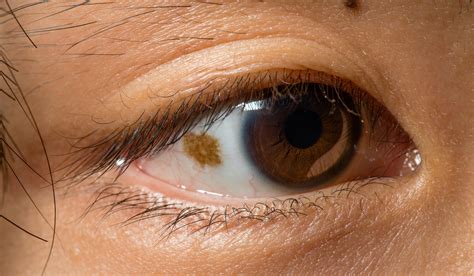 Spots In Vision After Birth at Caleb Fernando blog