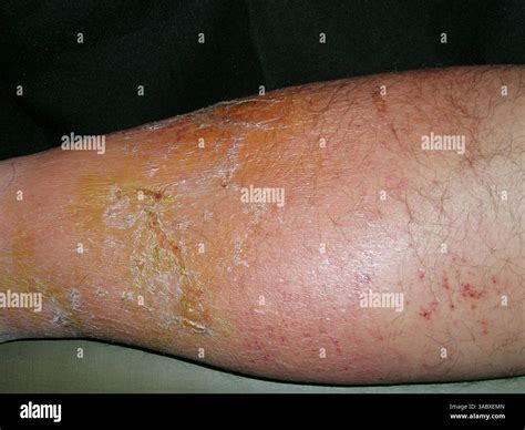Cellulitis and impetigo on a patient's skin. Impetigo is a bacterial skin infection caused by ...