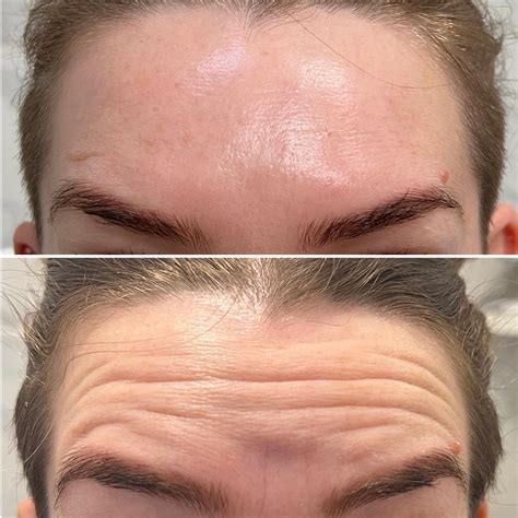 Botox Before and After: Photos and Everything You Need to Know