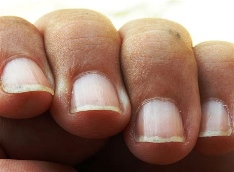 Signs Of Skin Cancer In Nails at Sara Wallen blog