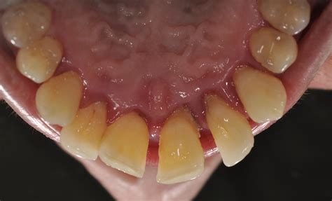 Loose Tooth Adults | Loose Tooth Treatment For Adults - PRVOE