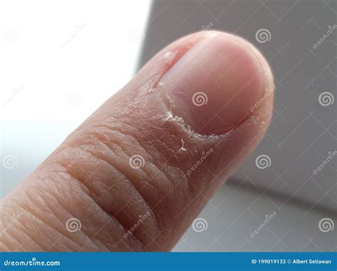 Close Up of My Index Fingers with Dry, Cracked Skin on Cuticles, Skin is Torn and Flaking Off ...