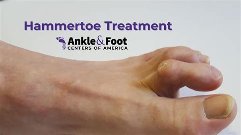 Hammer Toe Surgery to Correct Mallet Toe | Pete Smith, DPM