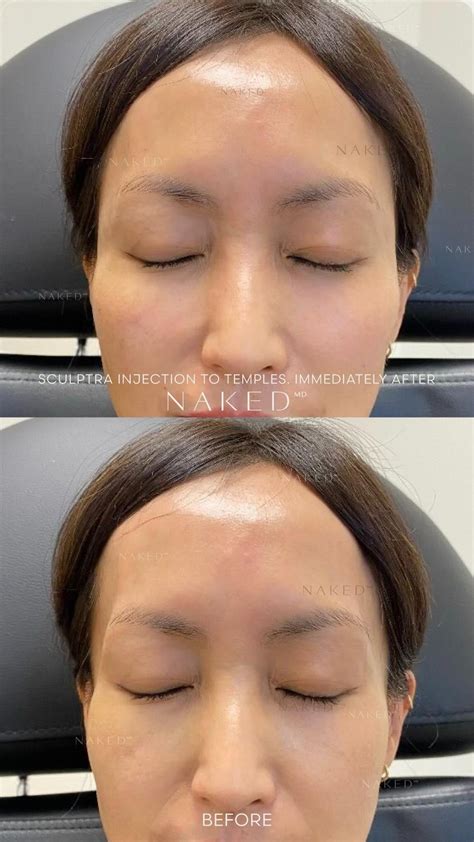 Sculptra® Filler & Injections in California and Arizona – NAKEDMD Medspa
