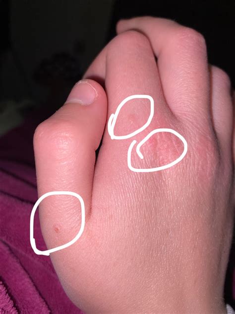 What are these bumps on my hand? : r/DiagnoseMe