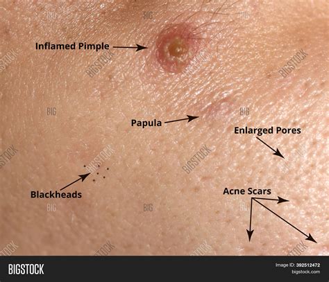 Large Pores Blackheads