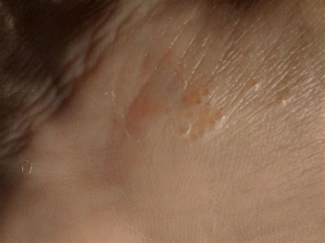Water Bubbles Under Skin at Mitchell Cushing blog