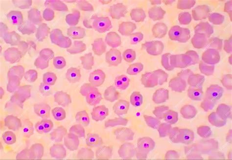 Malaria parasite pv plasmodium vivex blood smear microscopic 100x image ...