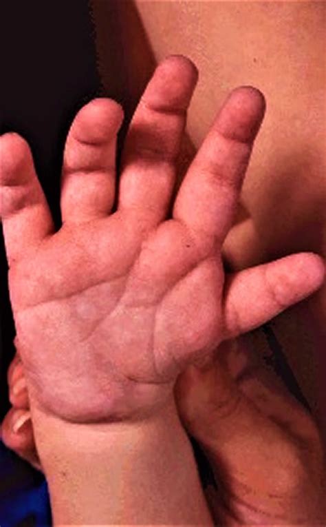 Charge Syndrome Life Expectancy