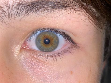 Central Heterochromia Hazel
