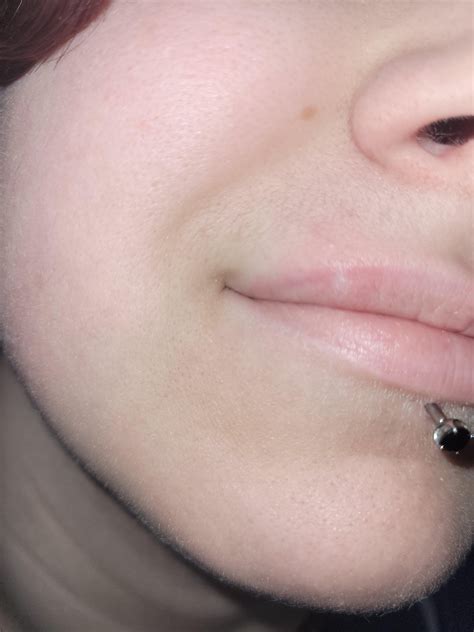 Tight bump on lip, white in better lighting : r/HealthQuestions