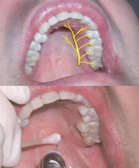 Greater palatine nerve block in 2025 | Dental help, Dental hygiene ...