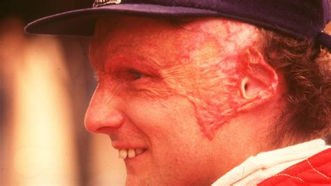 This Day In History: Niki Lauda Severely Injured In F1 Crash At The ...