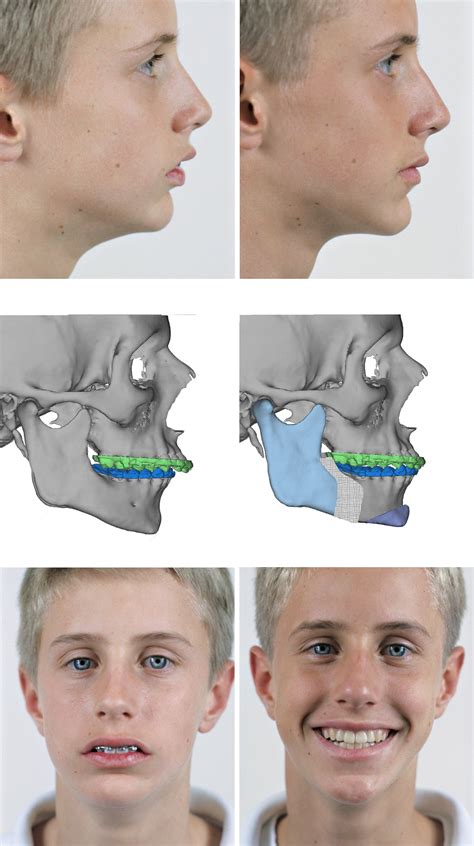 Overbite Before And After Side View Orthognathic Jaw Surgery Before