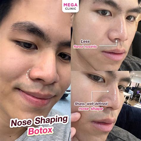 โบท็อกจมูก ดียังไง แก้จมูกบาน เก็บทรงจมูกสวยเป๊ะ | MEGA CLINIC
