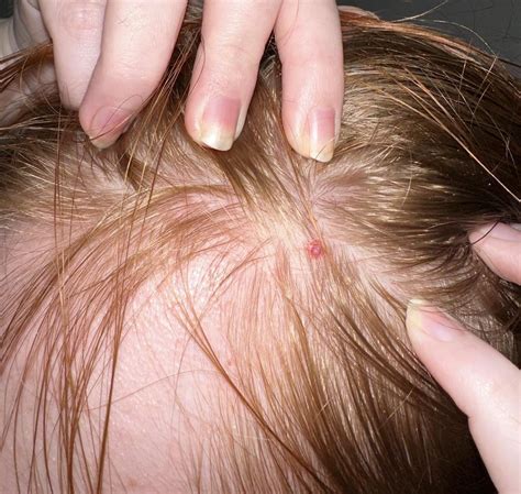 What is this lump on my head? : r/DermatologyQuestions