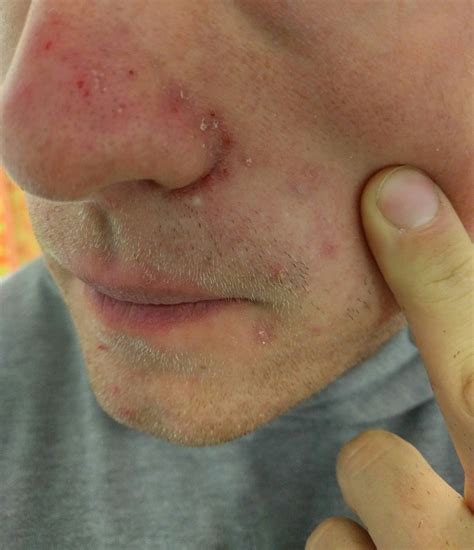 Acne Cyst Nose