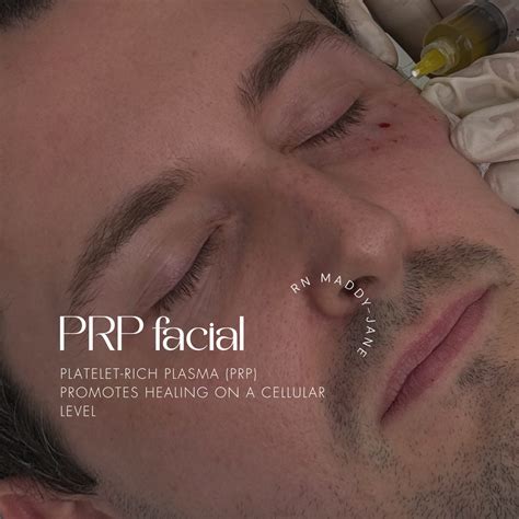 The science behind PRP. PRP harnesses the power of platelets from your ...