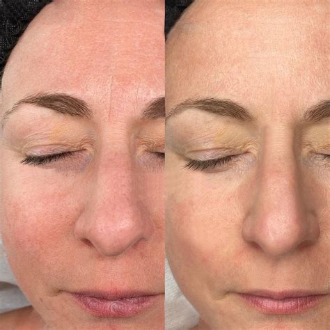 Korabeauticals V2 Reviews: My Before and After Photos From the At-Home Microneedling Device ...