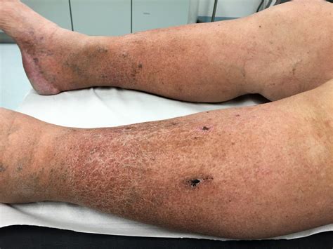 Causes Of Venous Stasis Dermatitis