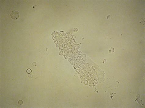 Red blood cells casts