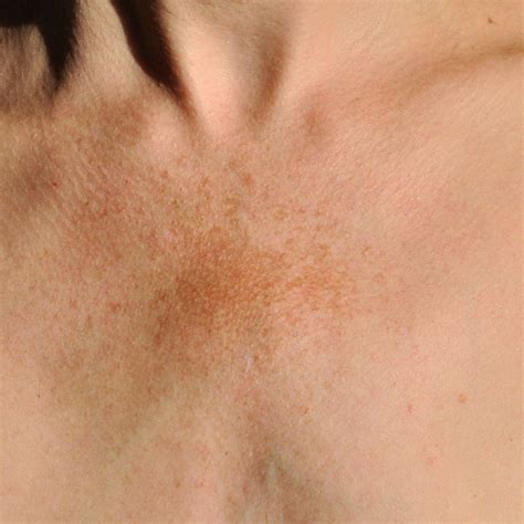 How to remove sun spots, melasma on skin?