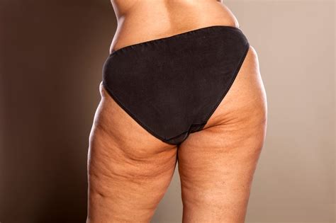 Quelles Sont Les Causes De L’apparition De La Cellulite ? ☎️ 0622742529