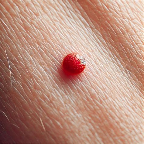 Red Mole on Your Skin #MedicalAwareness #CherryAngioma | Nazia Parveen posted on the topic ...