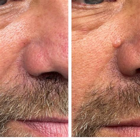 Mole Removal & Mole Removal on Face Jacksonville