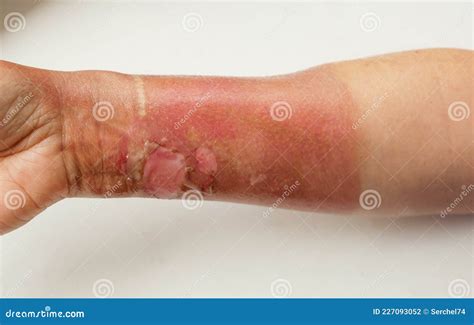 How To Treat Boiling Water Burn Scar at Daryl Wherry blog