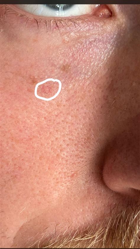 Dry Patches On Penus