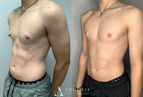 Chest Feels Tight After Gynecomastia Surgery at Mark Lola blog