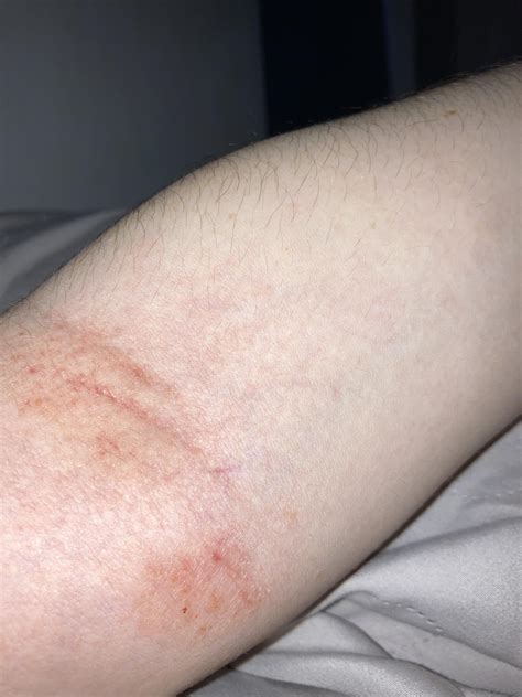 Rash on inner elbow : r/DiagnoseMe