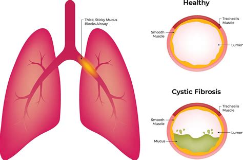 Healthy Cystic Fibrosis Science Design Illustration Diagram 54945852 Vector Art at Vecteezy
