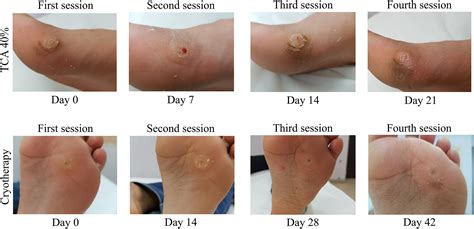 Stages Of Verruca Dying
