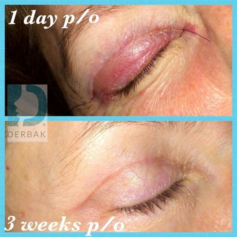 Laser Blepharoplasty 1 Day Post Op » Eyelid Surgery: Cost, Photos, Rewiews, Q&A