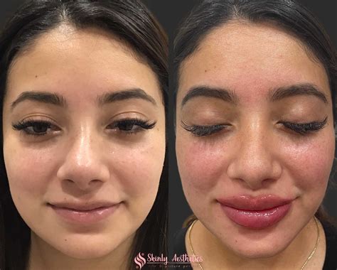 Russian Lip Filler Before & After Results - Skinly Aesthetics