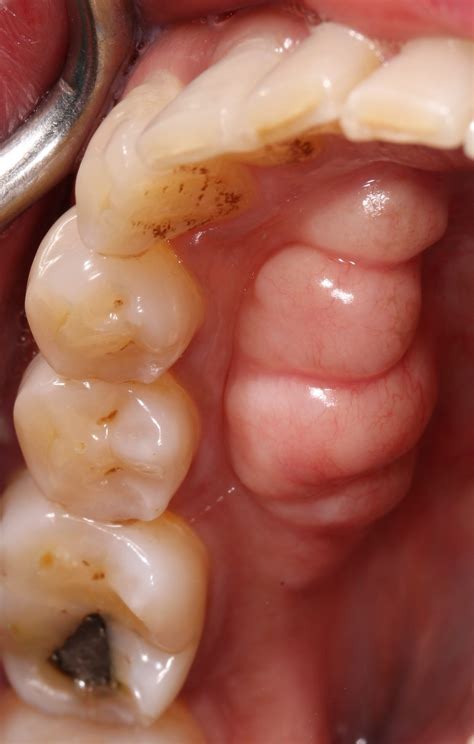 Torus Mandibularis Cancer